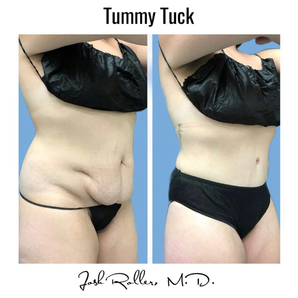 Tummy Tuck and Abdominoplasty Before & After Gallery - Patient 86641426 - Image 9