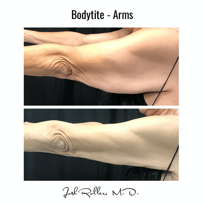 BodyTite Before & After Gallery - Patient 86641446 - Image 2