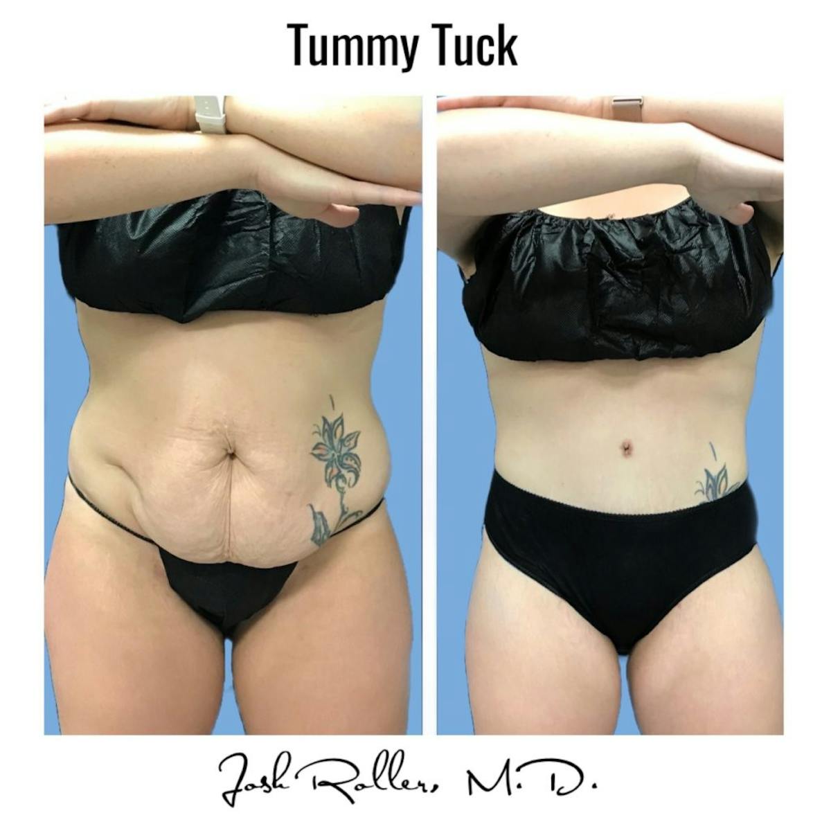 Tummy Tuck and Abdominoplasty Before & After Gallery - Patient 86641426 - Image 10