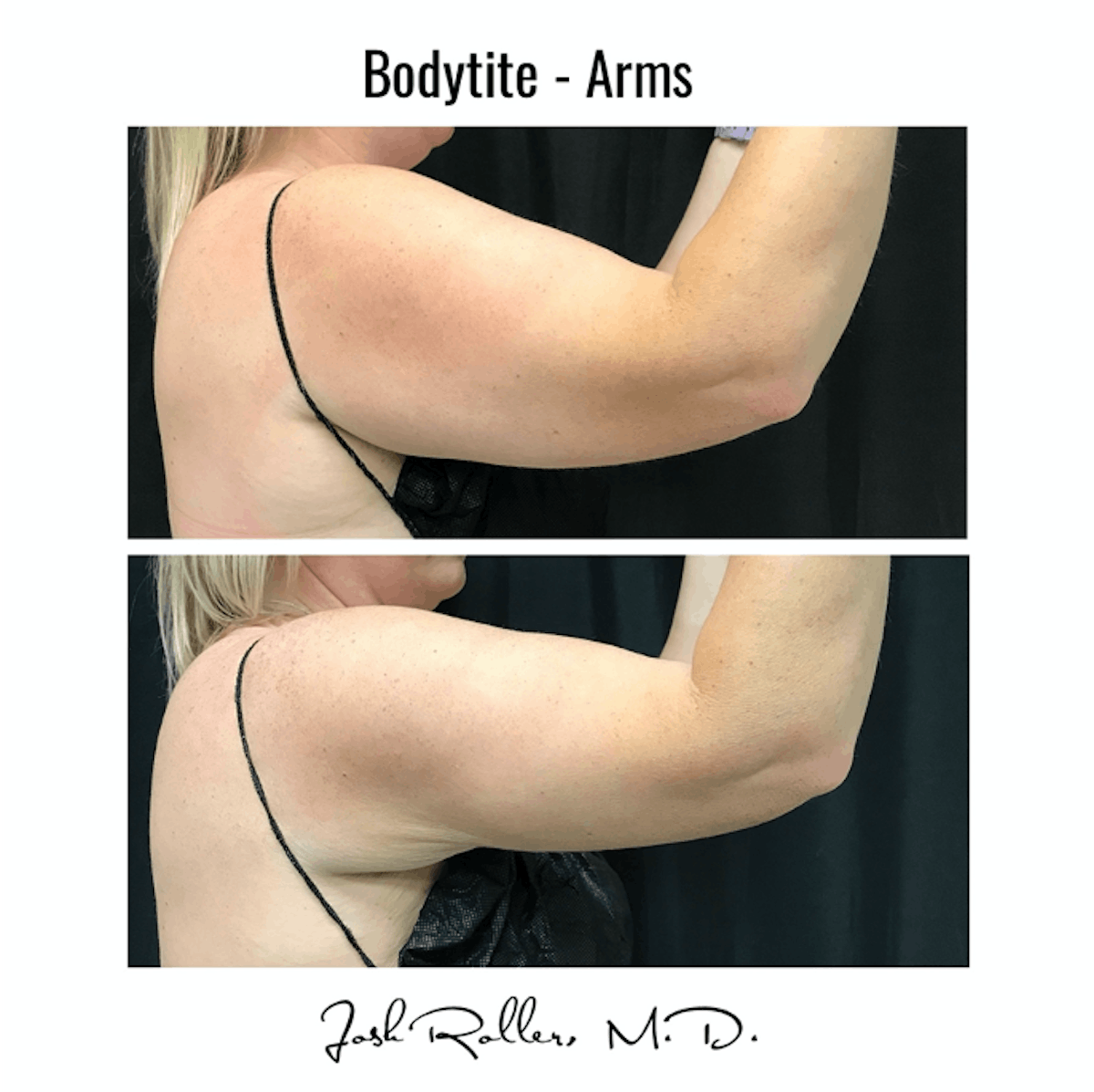 BodyTite Before & After Gallery - Patient 86641450 - Image 1