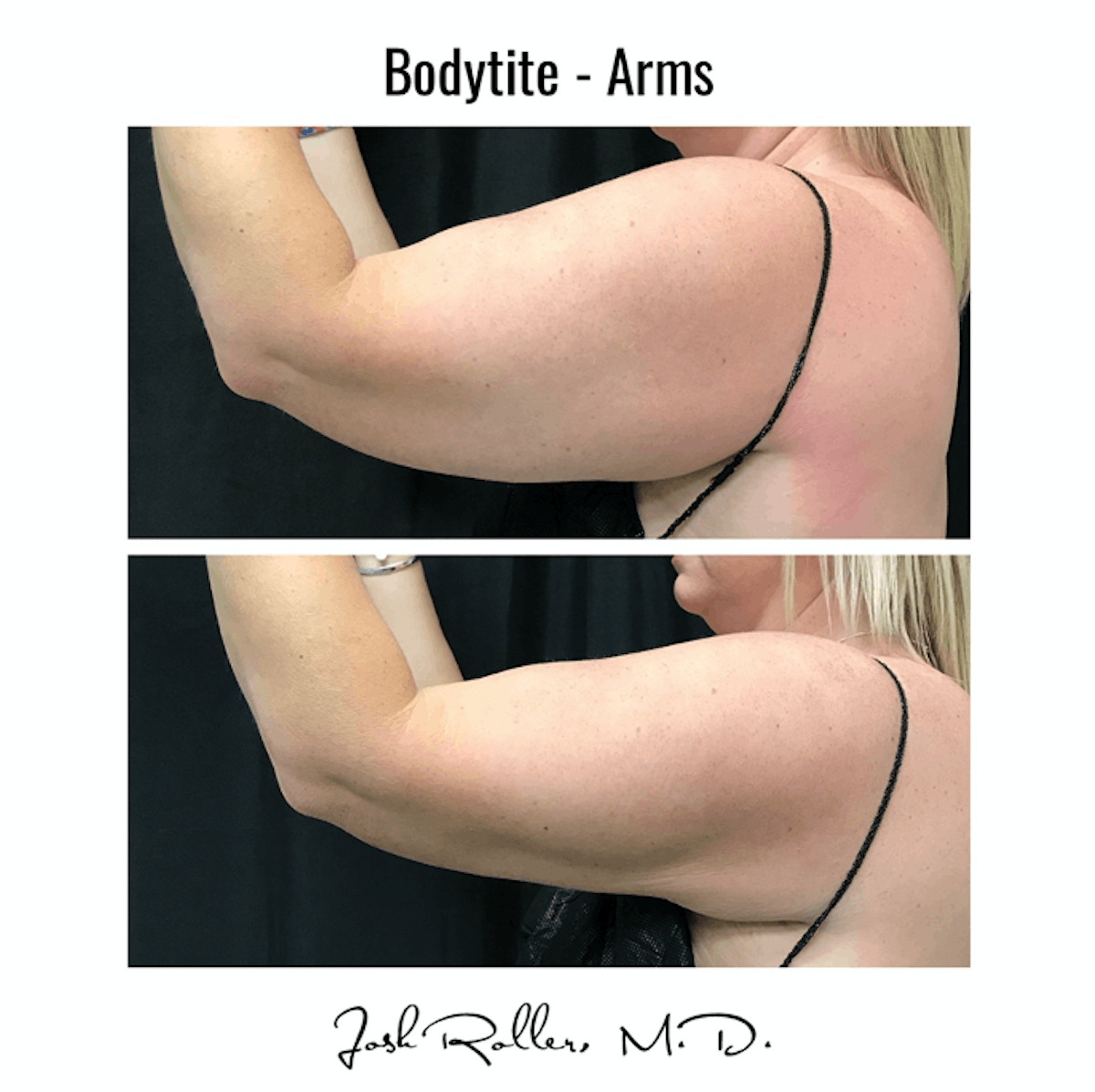 BodyTite Before & After Gallery - Patient 86641450 - Image 2