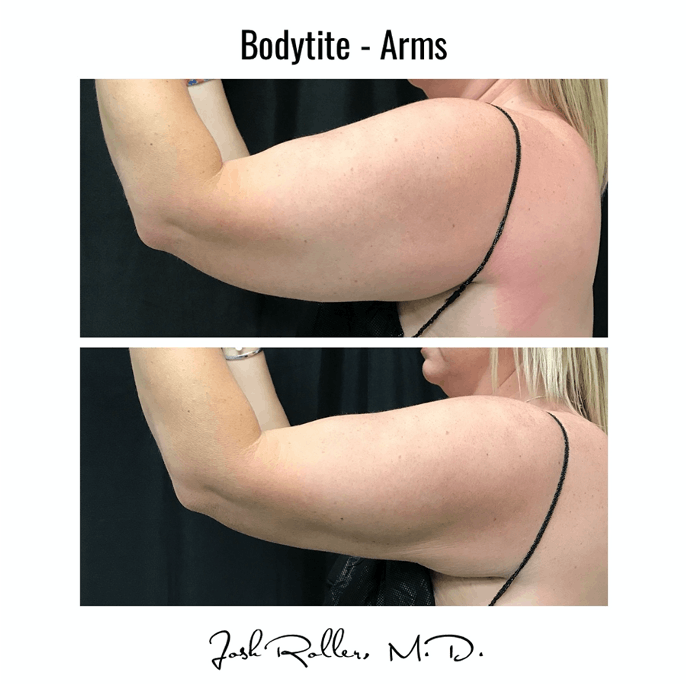 BodyTite Before & After Gallery - Patient 86641450 - Image 2
