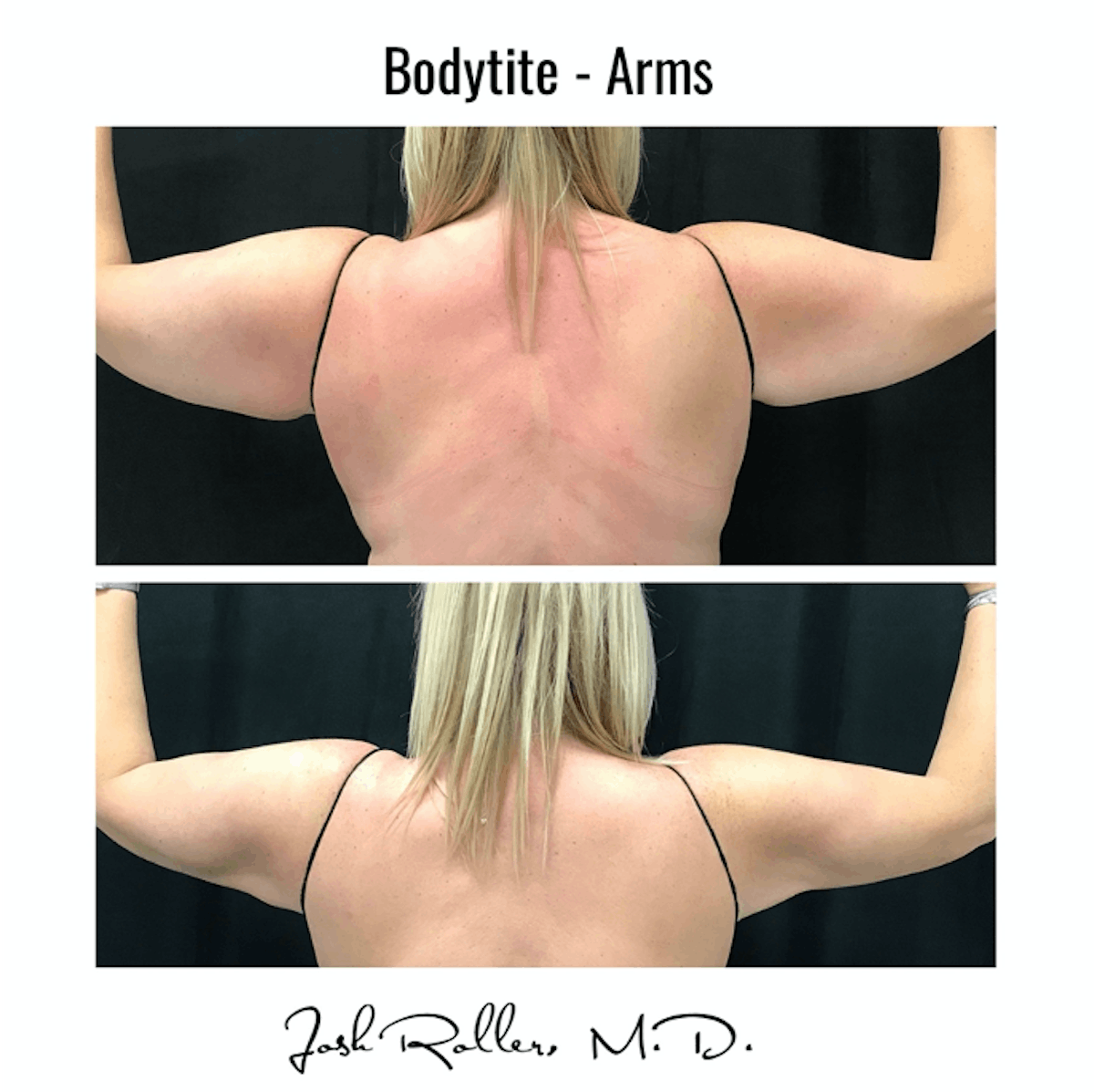 BodyTite Before & After Gallery - Patient 86641450 - Image 3