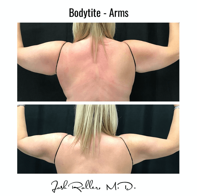 BodyTite Before & After Gallery - Patient 86641450 - Image 3