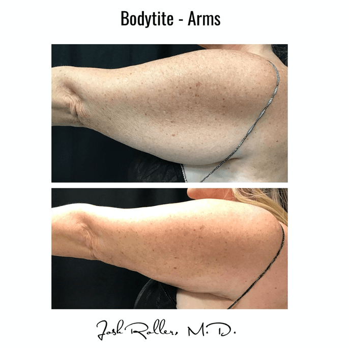 BodyTite Before & After Gallery - Patient 86641453 - Image 1