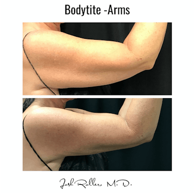 BodyTite Before & After Gallery - Patient 86641455 - Image 1