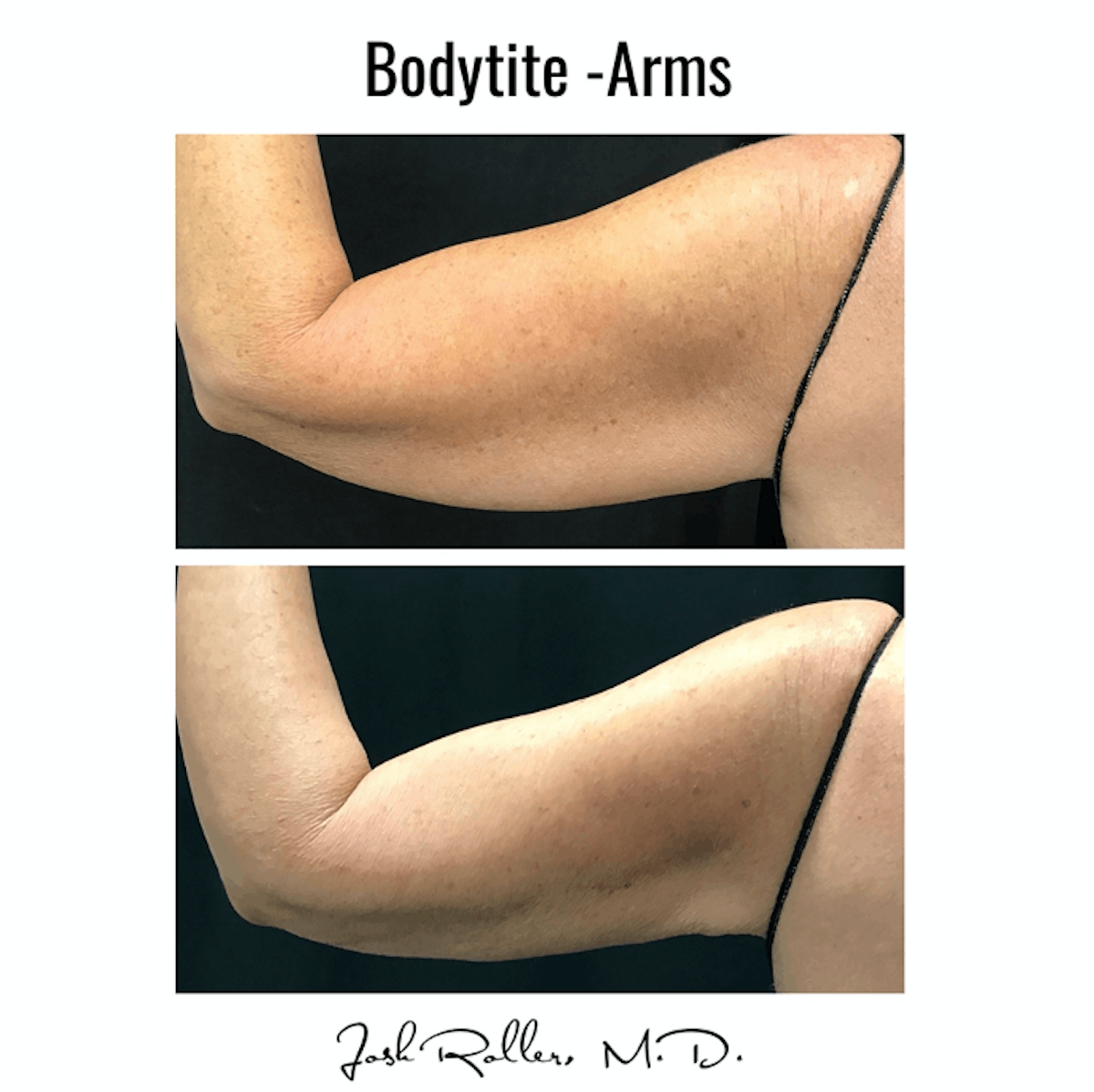 BodyTite Before & After Gallery - Patient 86641455 - Image 2