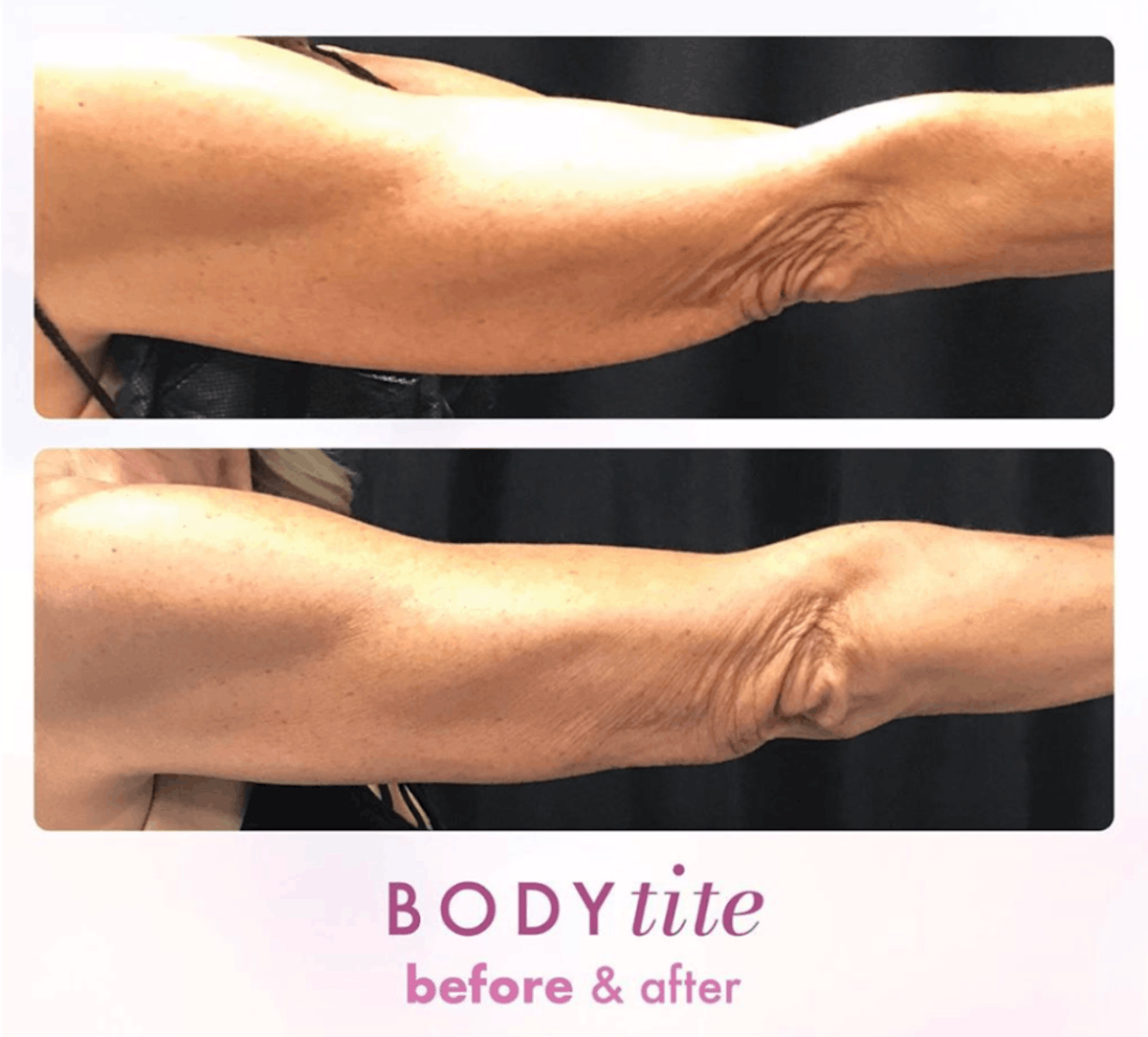 BodyTite Before & After Gallery - Patient 86641458 - Image 1