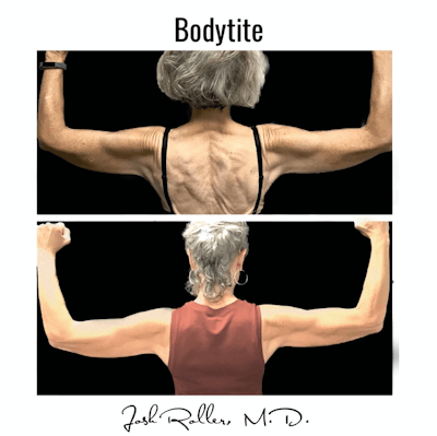 BodyTite Before & After Gallery - Patient 86641459 - Image 1