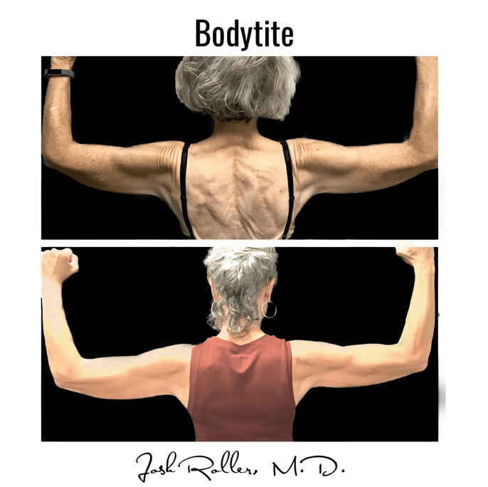 BodyTite Before & After Gallery - Patient 86641459 - Image 1