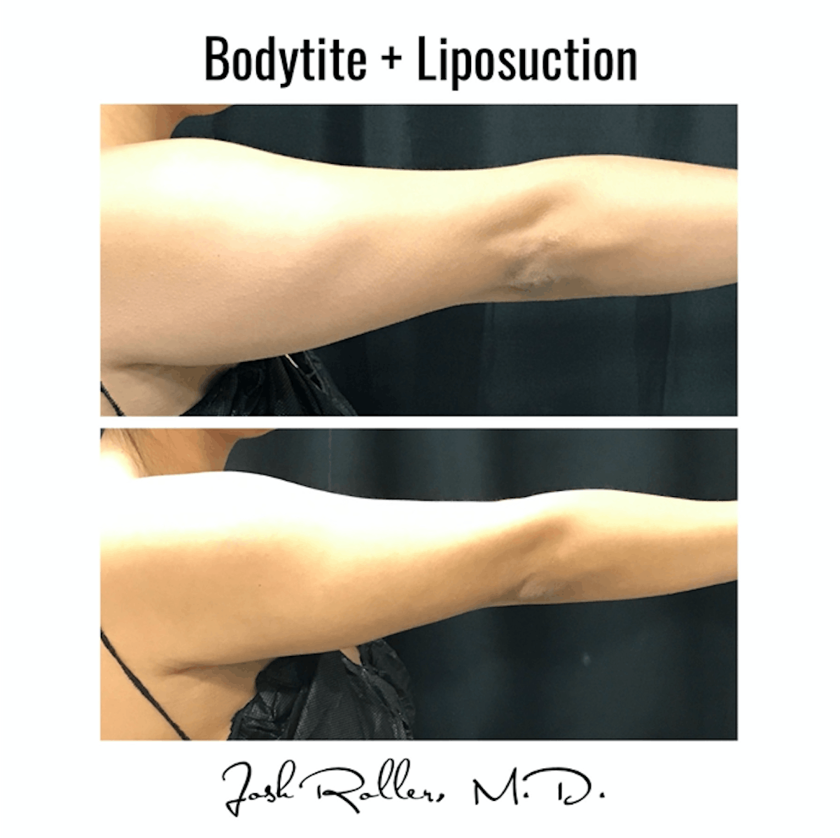 BodyTite Before & After Gallery - Patient 86641460 - Image 1