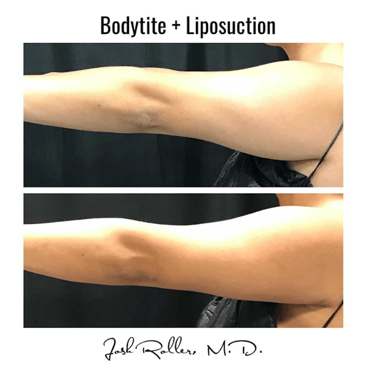 BodyTite Before & After Gallery - Patient 86641460 - Image 2