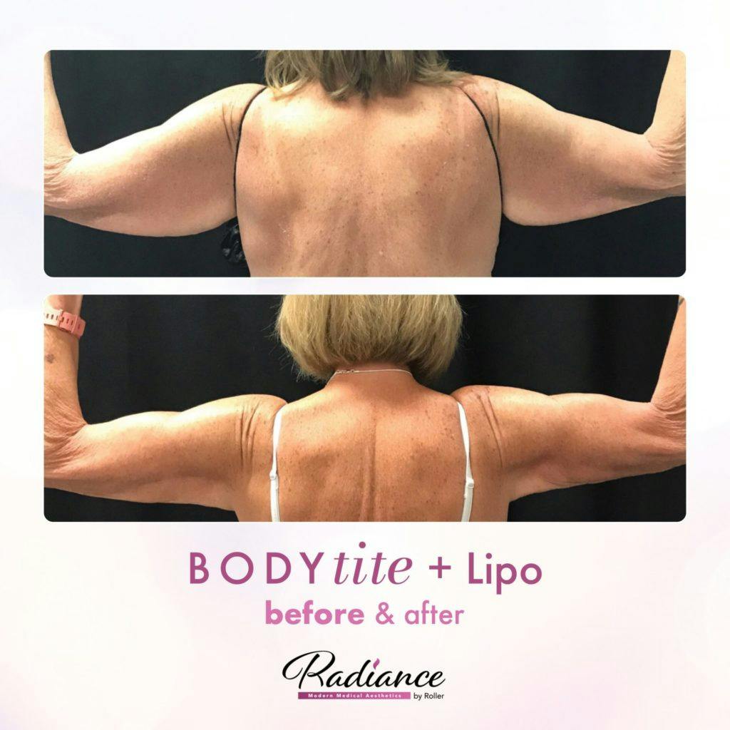 BodyTite Before & After Gallery - Patient 86641464 - Image 1