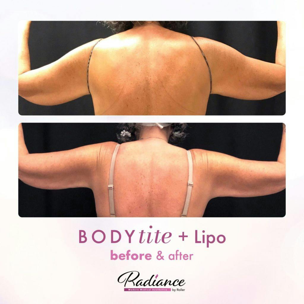 BodyTite Before & After Gallery - Patient 86641465 - Image 1