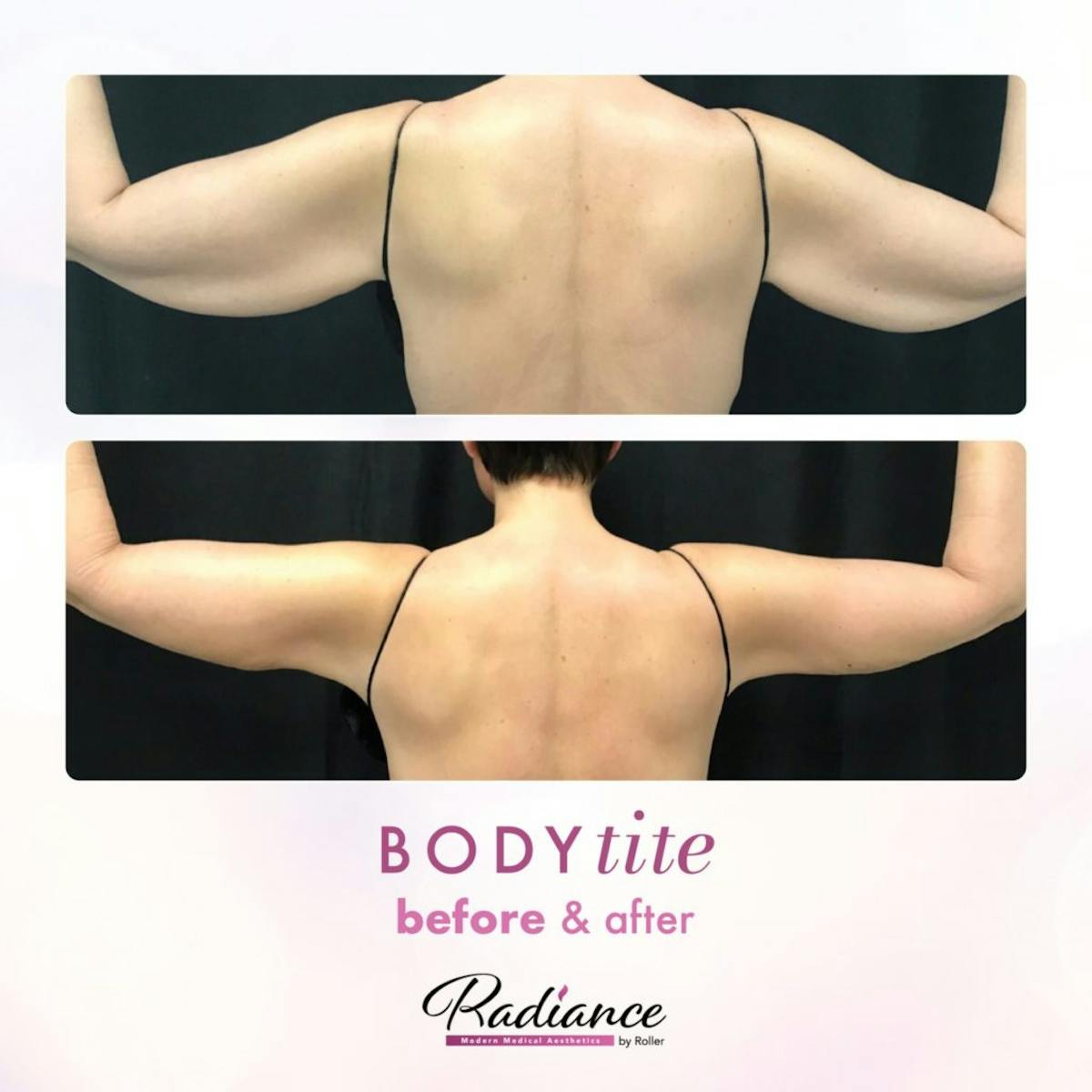 BodyTite Before & After Gallery - Patient 86641466 - Image 1