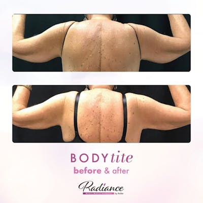 BodyTite Before & After Gallery - Patient 86641467 - Image 1