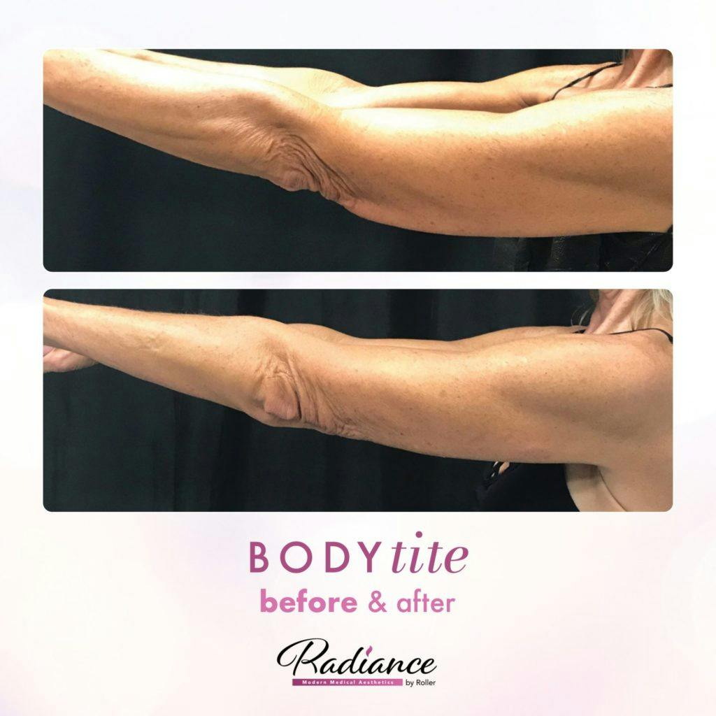 BodyTite Before & After Gallery - Patient 86641467 - Image 2