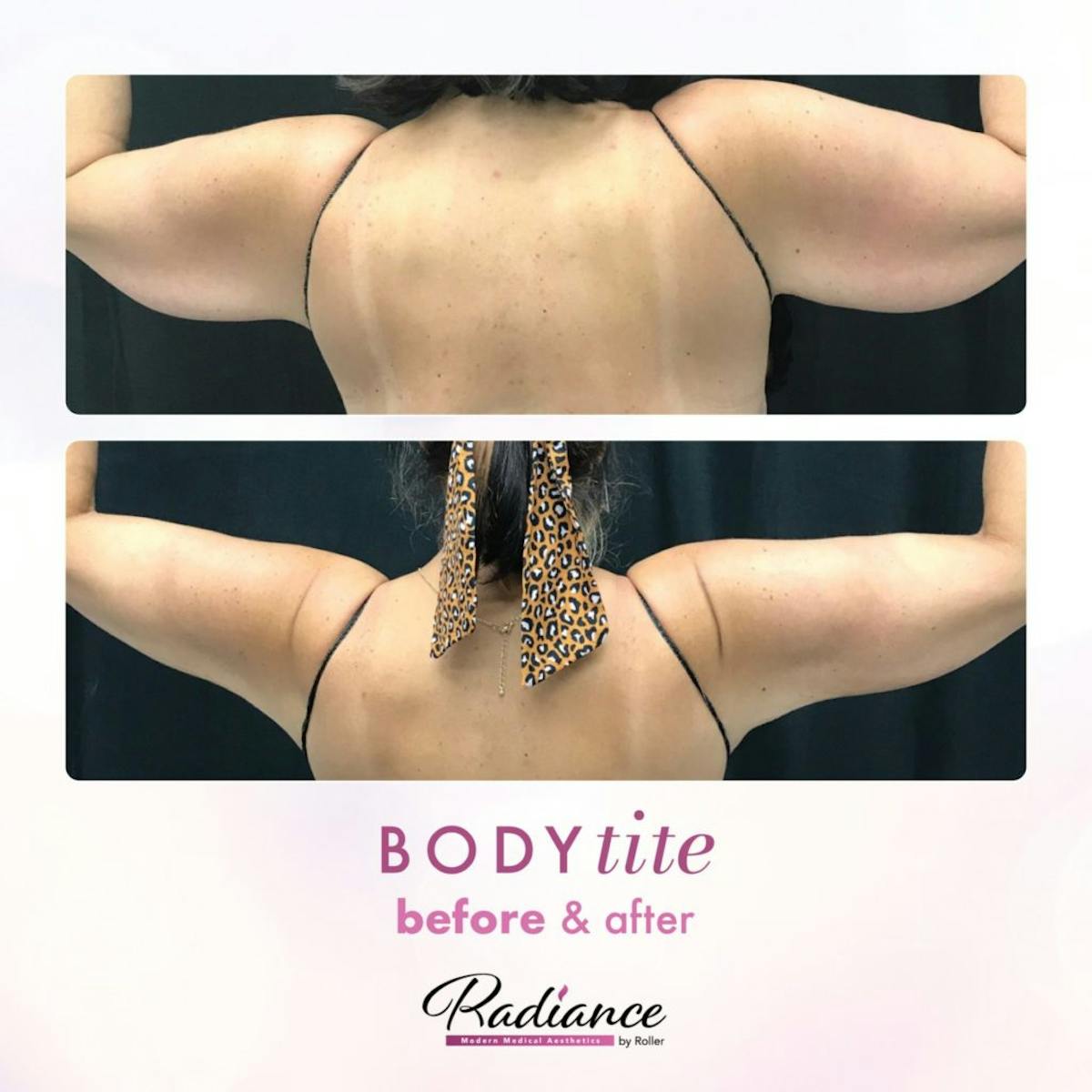 BodyTite Before & After Gallery - Patient 86641469 - Image 1