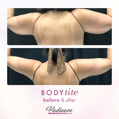 BodyTite Before & After Gallery - Patient 86641469 - Image 1