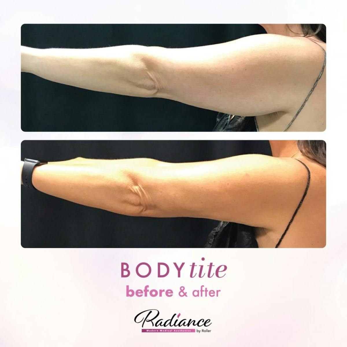 BodyTite Before & After Gallery - Patient 86641469 - Image 2