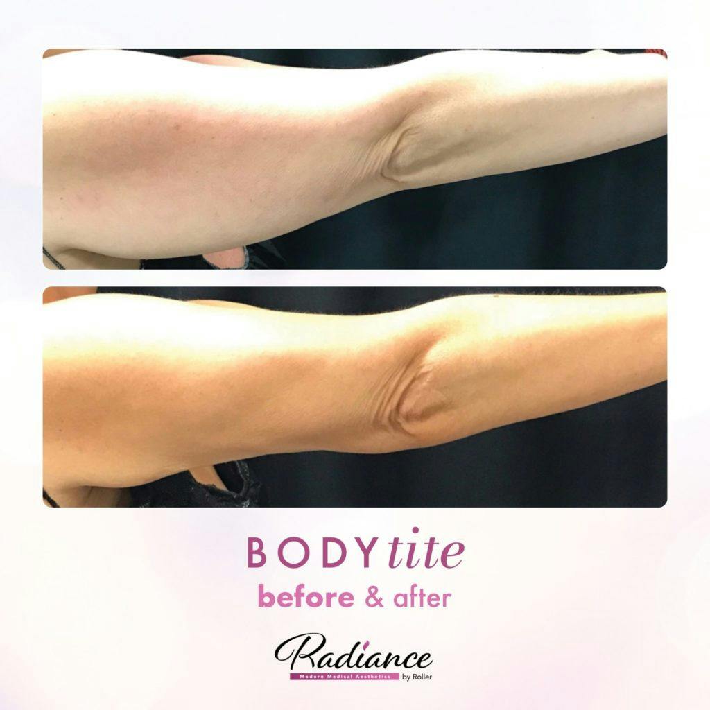 BodyTite Before & After Gallery - Patient 86641469 - Image 3