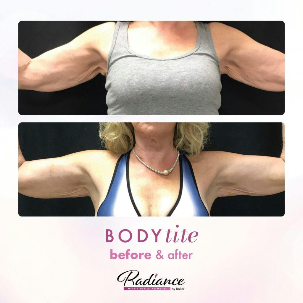 BodyTite Before & After Gallery - Patient 86641472 - Image 1