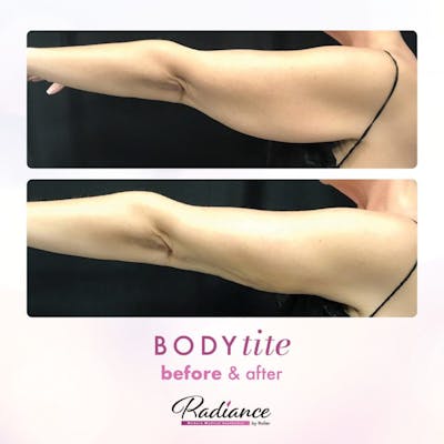 BodyTite Before & After Gallery - Patient 86641473 - Image 1