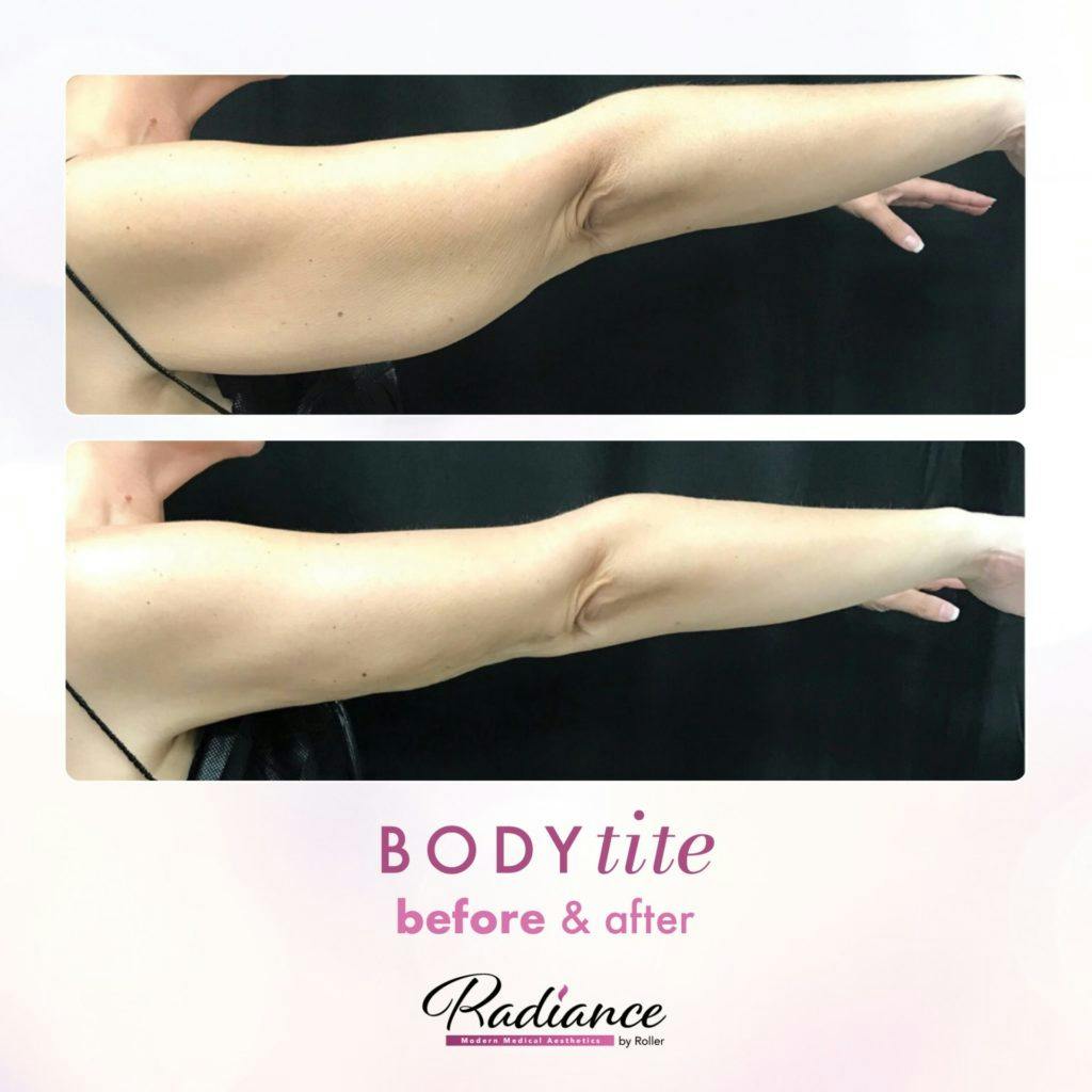 BodyTite Before & After Gallery - Patient 86641473 - Image 2