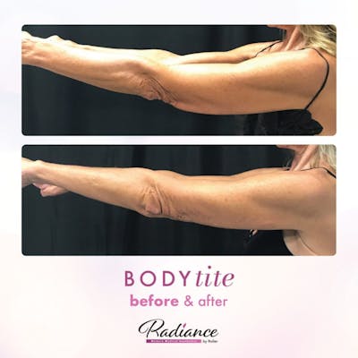 BodyTite Before & After Gallery - Patient 86641480 - Image 1