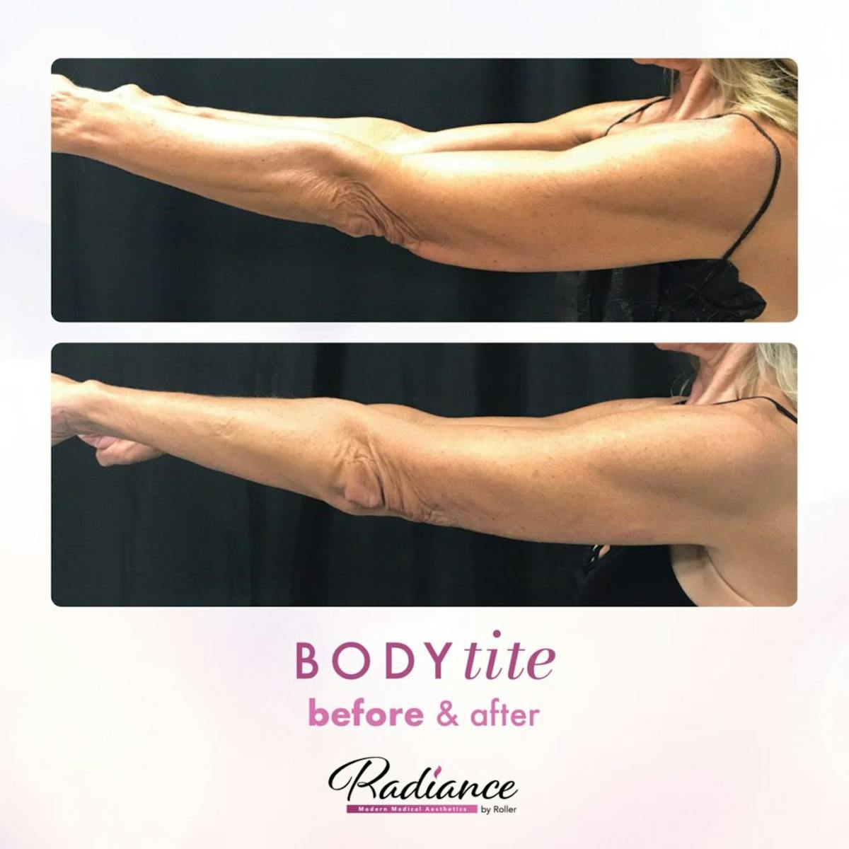 BodyTite Before & After Gallery - Patient 86641480 - Image 1