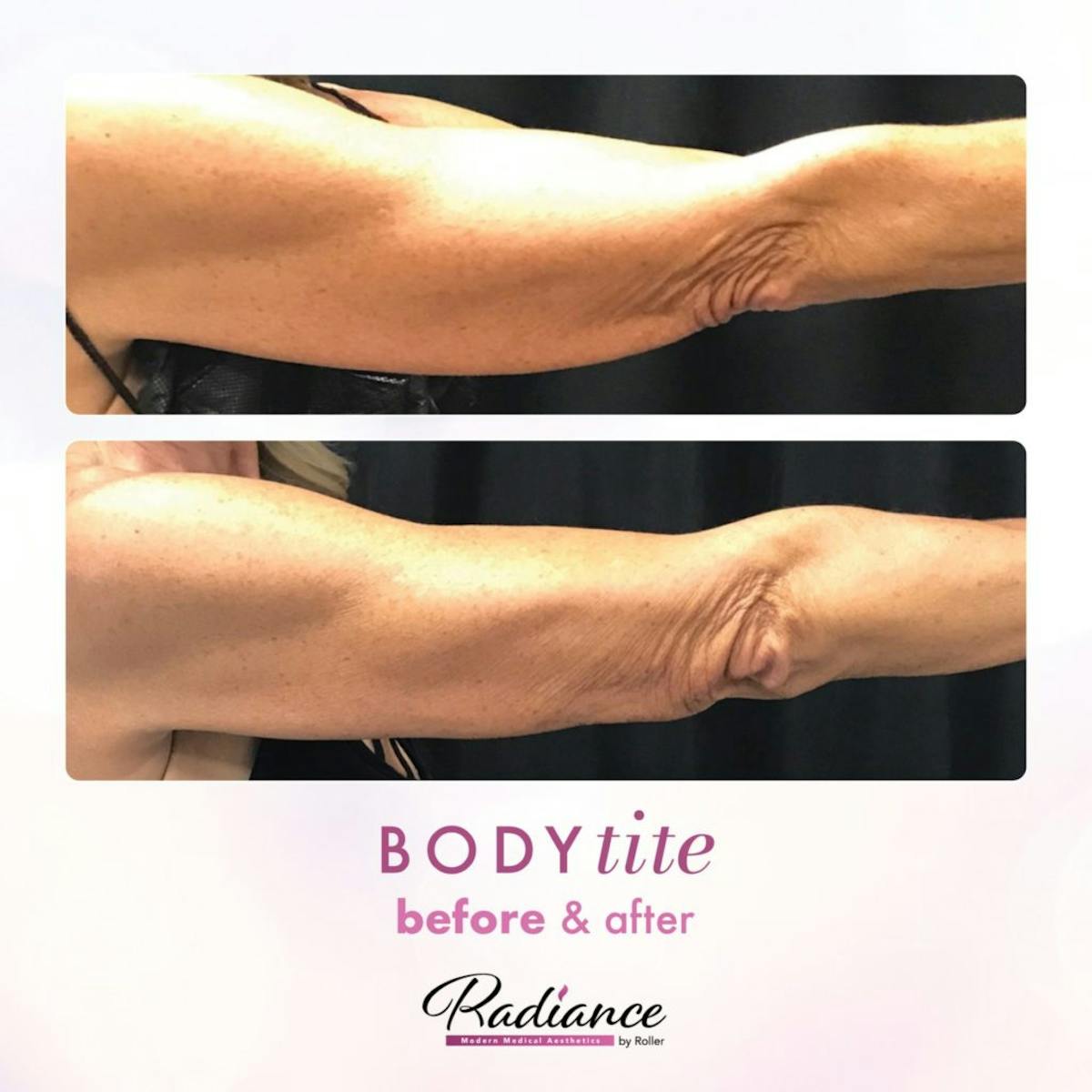 BodyTite Before & After Gallery - Patient 86641480 - Image 2