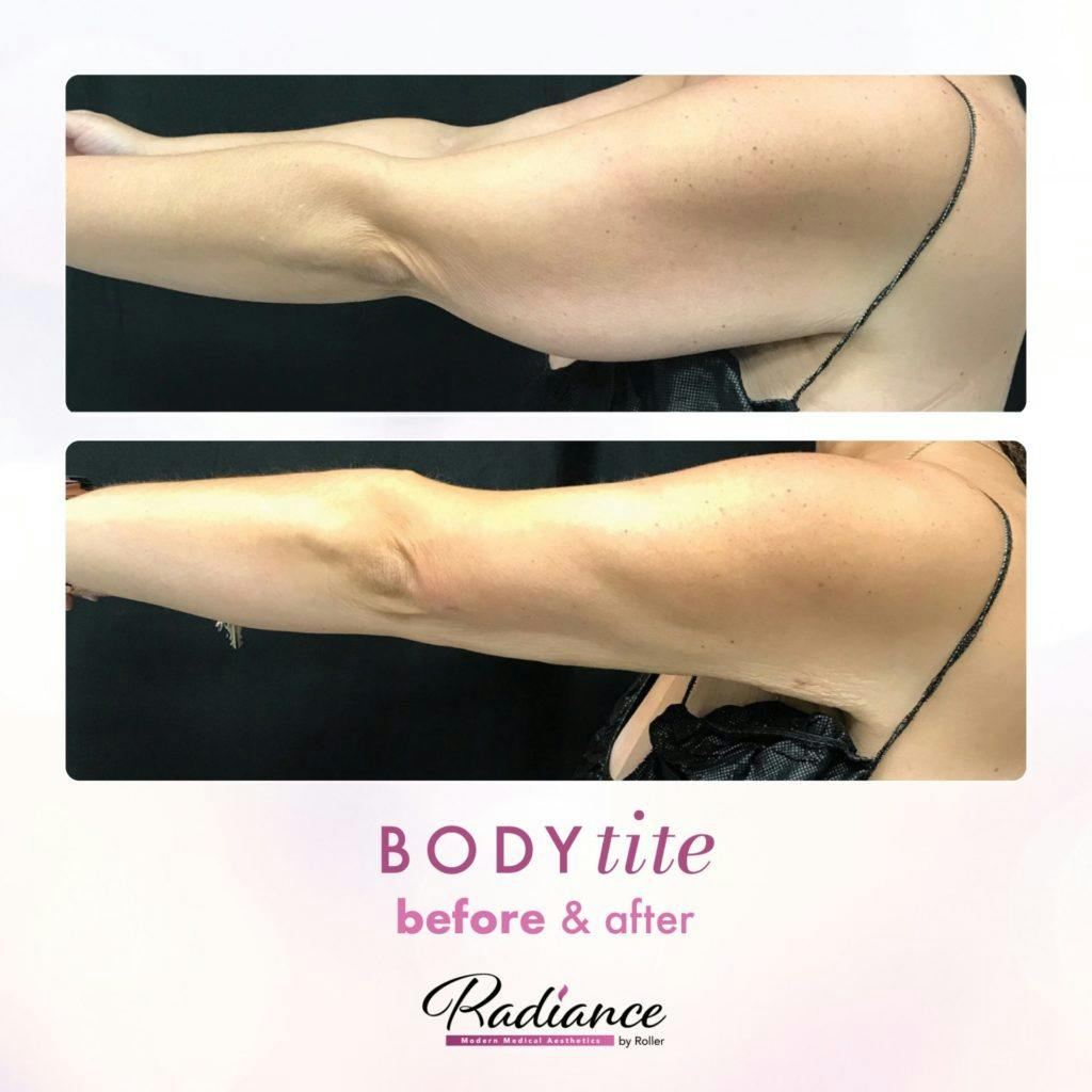 BodyTite Before & After Gallery - Patient 86641482 - Image 1