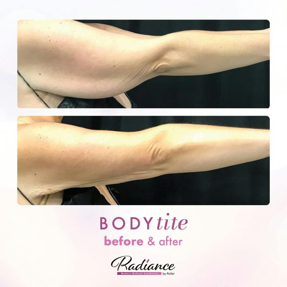 BodyTite Before & After Gallery - Patient 86641482 - Image 2