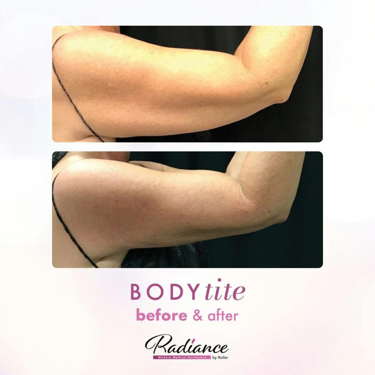 BodyTite Before & After Gallery - Patient 86643498 - Image 2