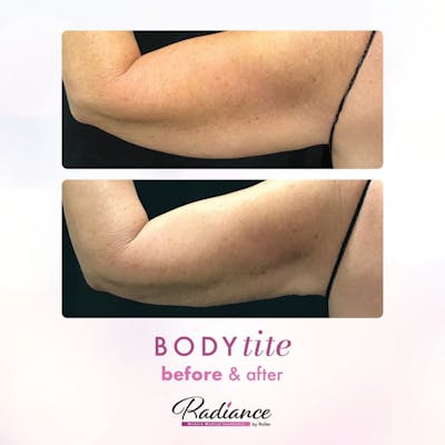 BodyTite Before & After Gallery - Patient 86643498 - Image 1