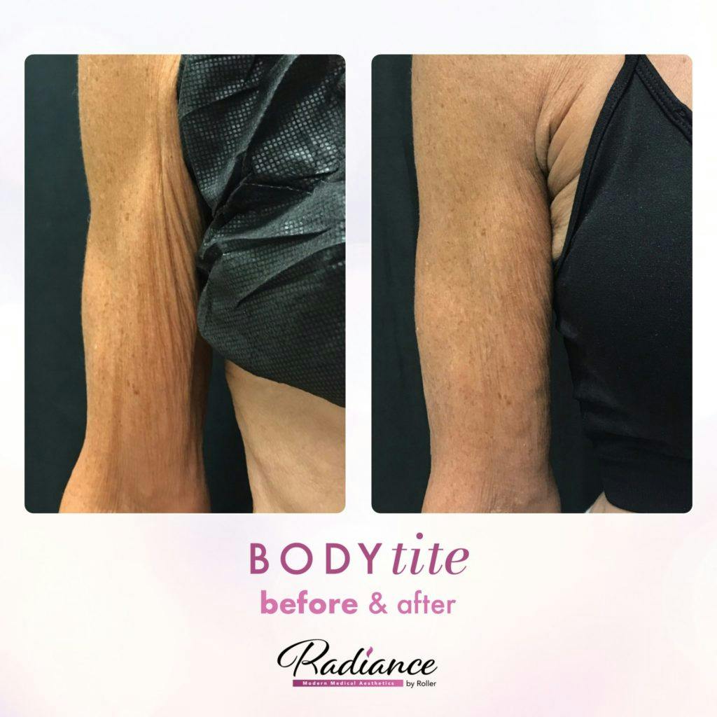 BodyTite Before & After Gallery - Patient 86643501 - Image 1