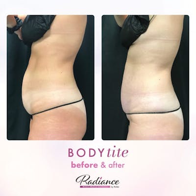 BodyTite Before & After Gallery - Patient 86643502 - Image 1