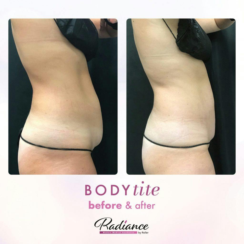 BodyTite Before & After Gallery - Patient 86643502 - Image 2