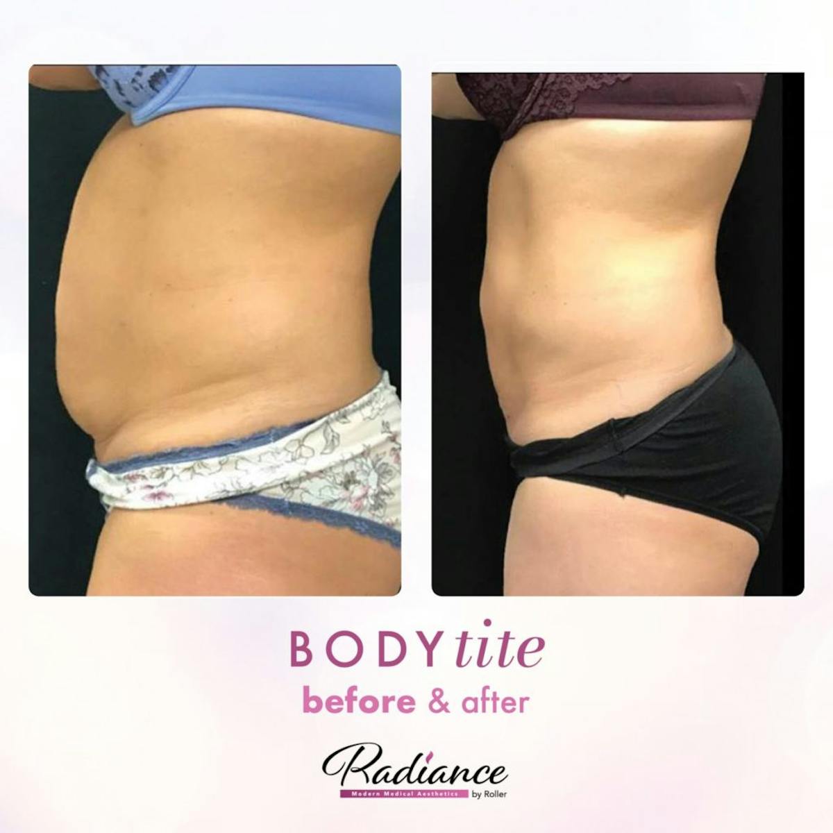 BodyTite Before & After Gallery - Patient 86643506 - Image 1