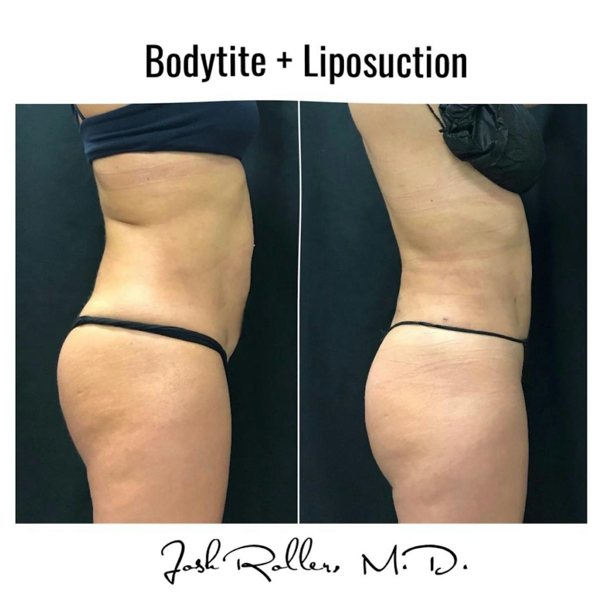 BodyTite Before & After Gallery - Patient 86643509 - Image 1