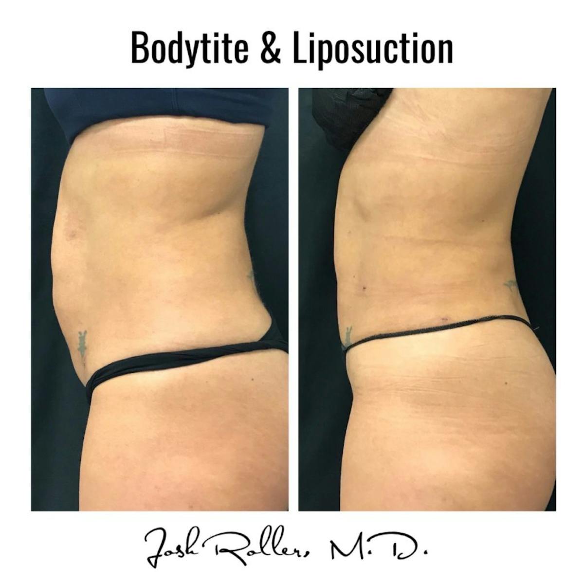 BodyTite Before & After Gallery - Patient 86643509 - Image 2