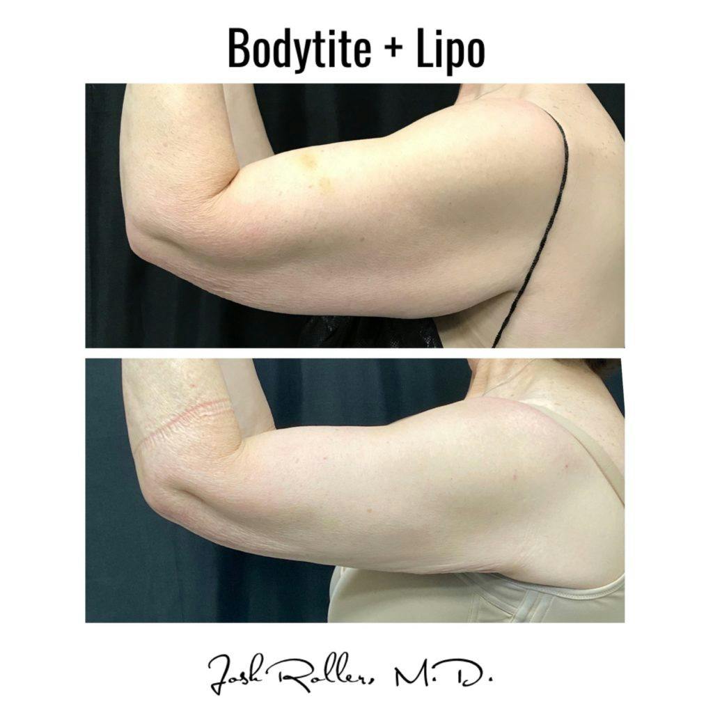 BodyTite Before & After Gallery - Patient 86643511 - Image 2