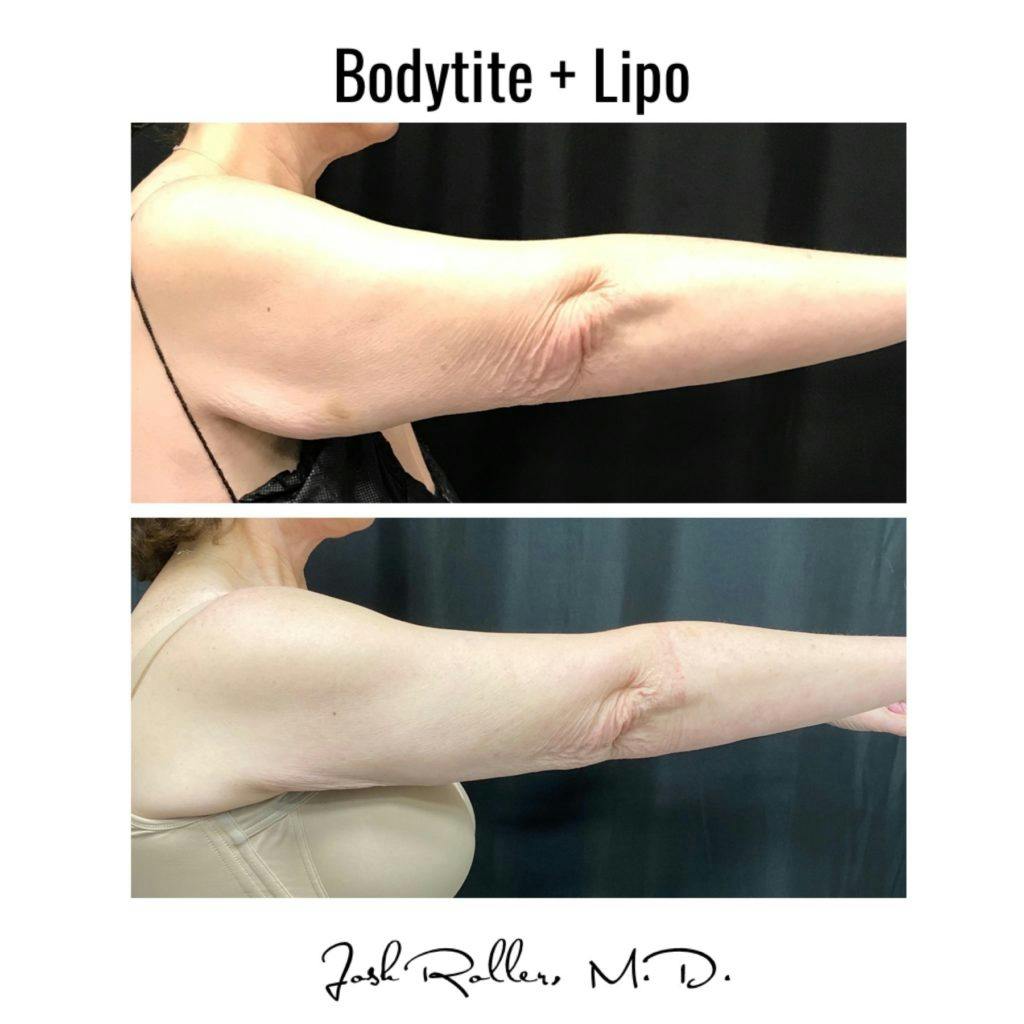 BodyTite Before & After Gallery - Patient 86643511 - Image 3