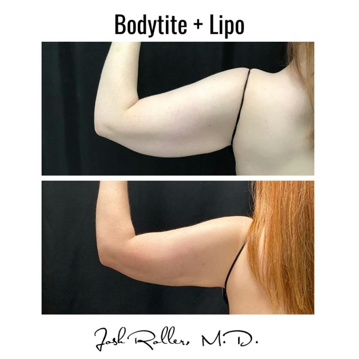 BodyTite Before & After Gallery - Patient 86643515 - Image 1