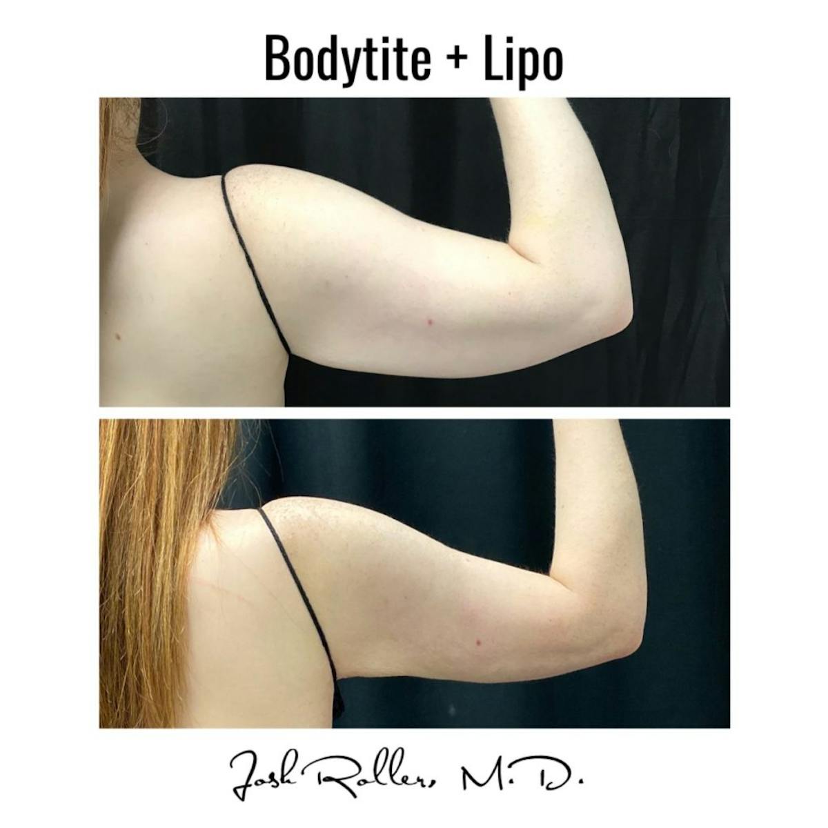BodyTite Before & After Gallery - Patient 86643515 - Image 2