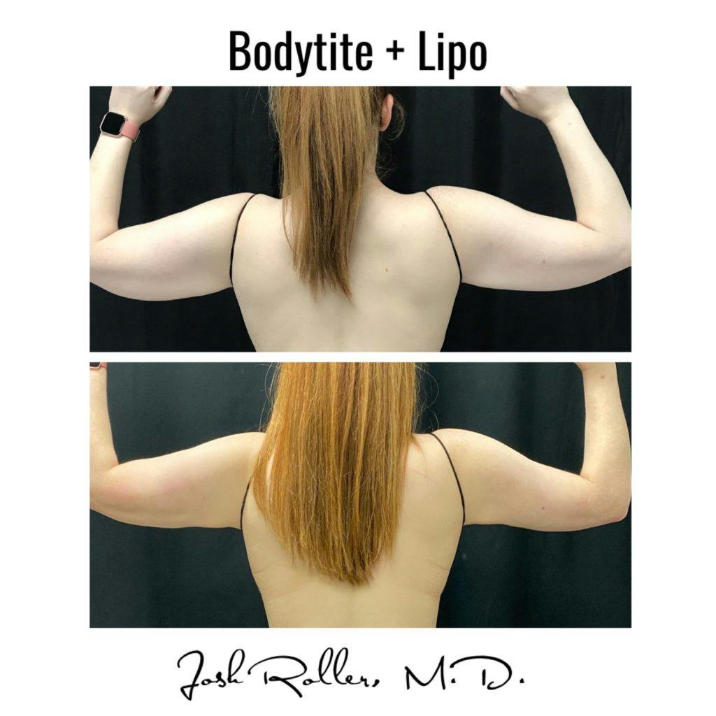 BodyTite Before & After Gallery - Patient 86643515 - Image 3