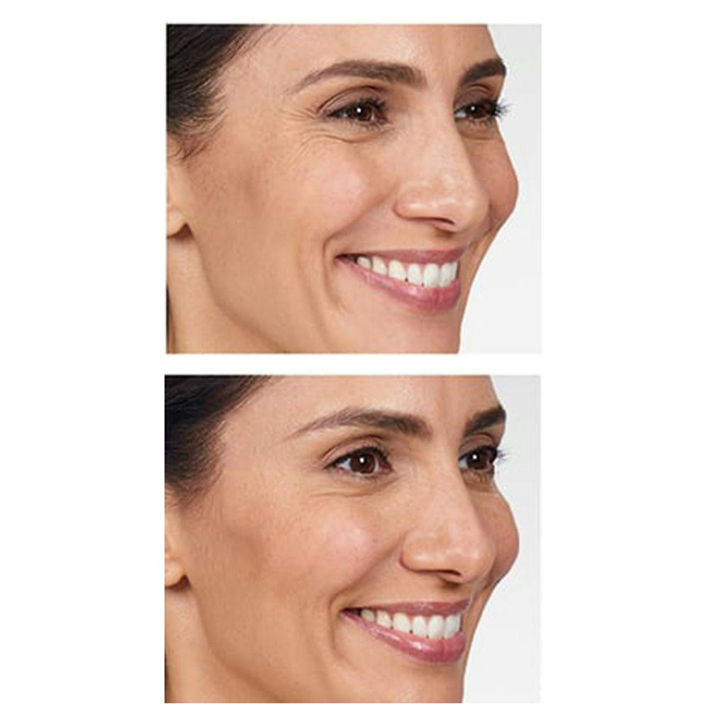 BOTOX Cosmetic Before & After Gallery - Patient 86641303 - Image 1
