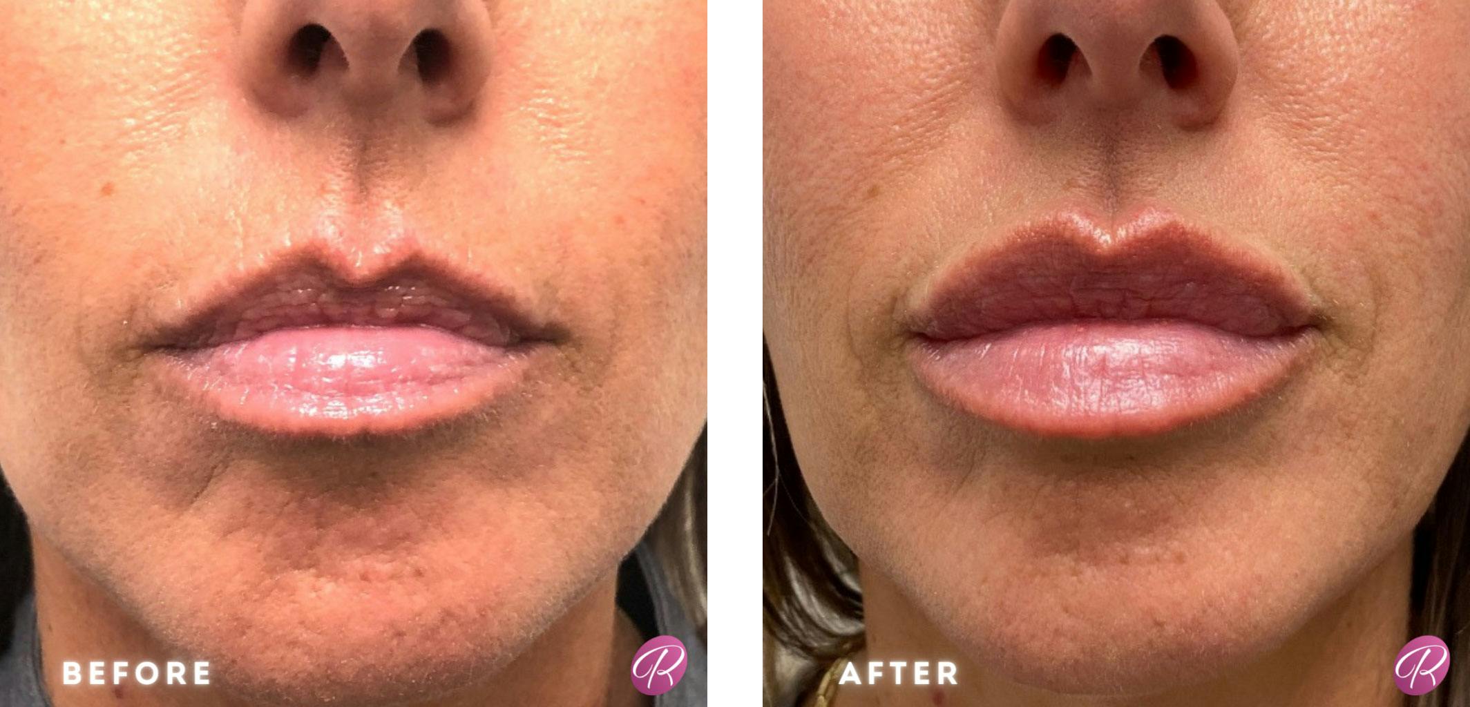 Juvederm Before & After Gallery - Patient 86641292 - Image 1