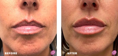 Juvederm Before & After Gallery - Patient 86641292 - Image 1