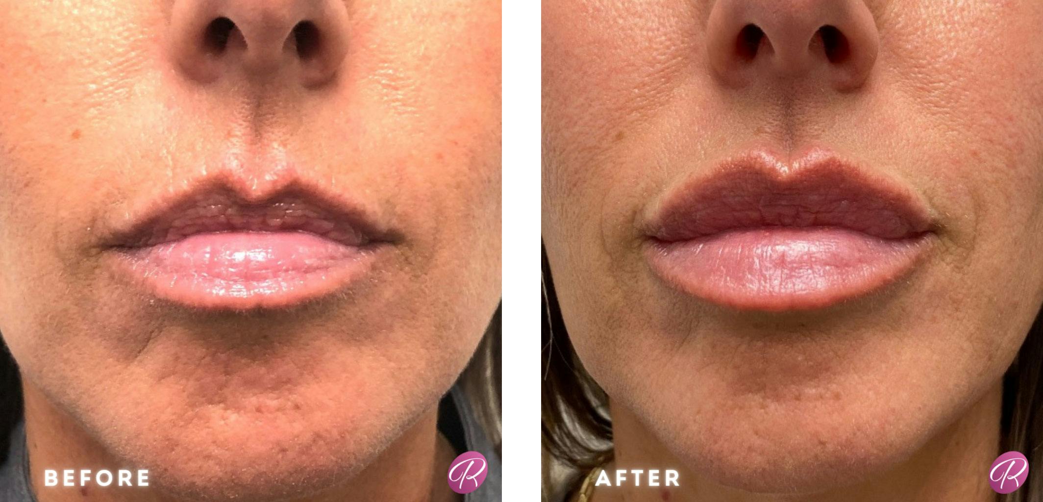 Juvederm Before & After Gallery - Patient 86641292 - Image 1